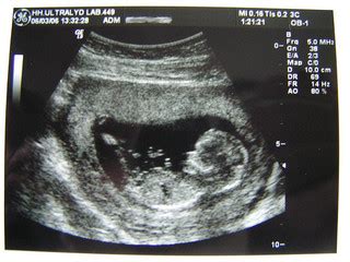 Pregnancy ultrasound county downers grove  Pay: $35
